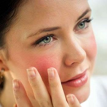 Rosacea Causes and Treatments
