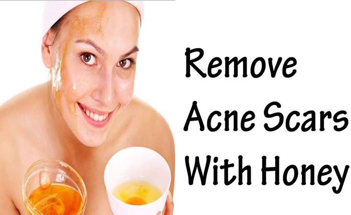Honey Treatment Acne