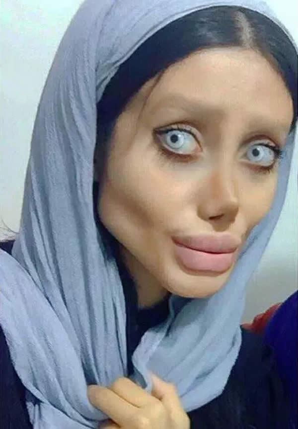 Iranian Teenage Girl Undergoes 50 Surgeries to Look Like Angelina Jolie!